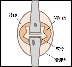 関節リウマチ ステージⅡ（進行期）