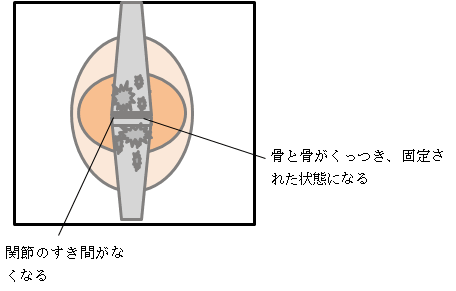 関節リウマチ ステージⅣ（末期）