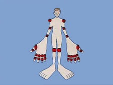 関節リウマチの活動性の評価